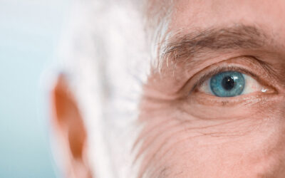 Nuclear Sclerotic Cataracts: Causes, Symptoms and Treatment