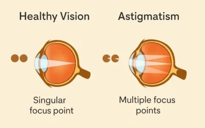 Are Toric Lenses Worth It for Mild Astigmatism?