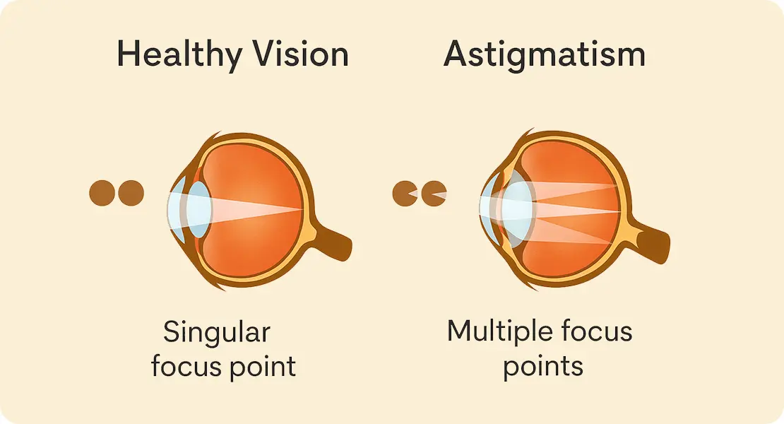 Astigmatism vs Healthy 1