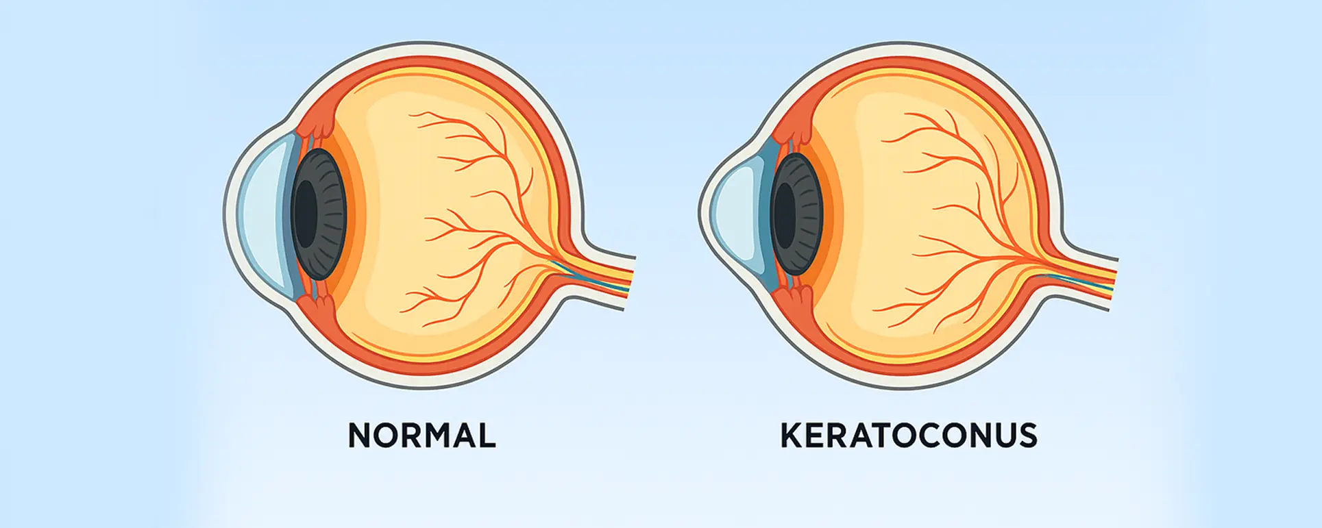 Cover Keratoconus 1