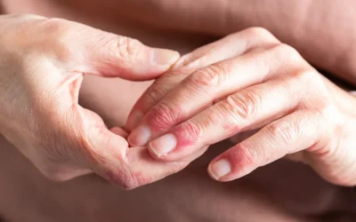 Cataract Surgery and Scleroderma: What You Need to Know