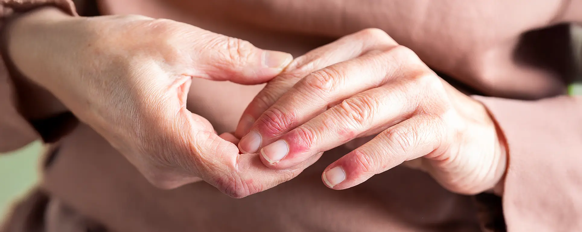 Cover Hands Sclerodema 1