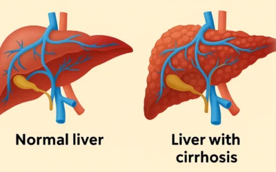 Cataract Surgery with Liver Cirrhosis: What You Need to Know