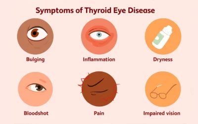 Cataract Surgery with Thyroid Eye Disease: What You Need to Know