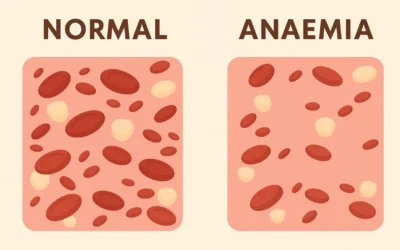 Cataract Surgery with Chronic Anaemia: What You Should Know