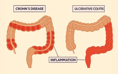 Having Cataract Surgery When You Have Crohn’s Disease: What to Be Aware Of
