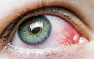 YAG Capsulotomy and Dry Eyes: Can the Laser Make Irritation Worse?