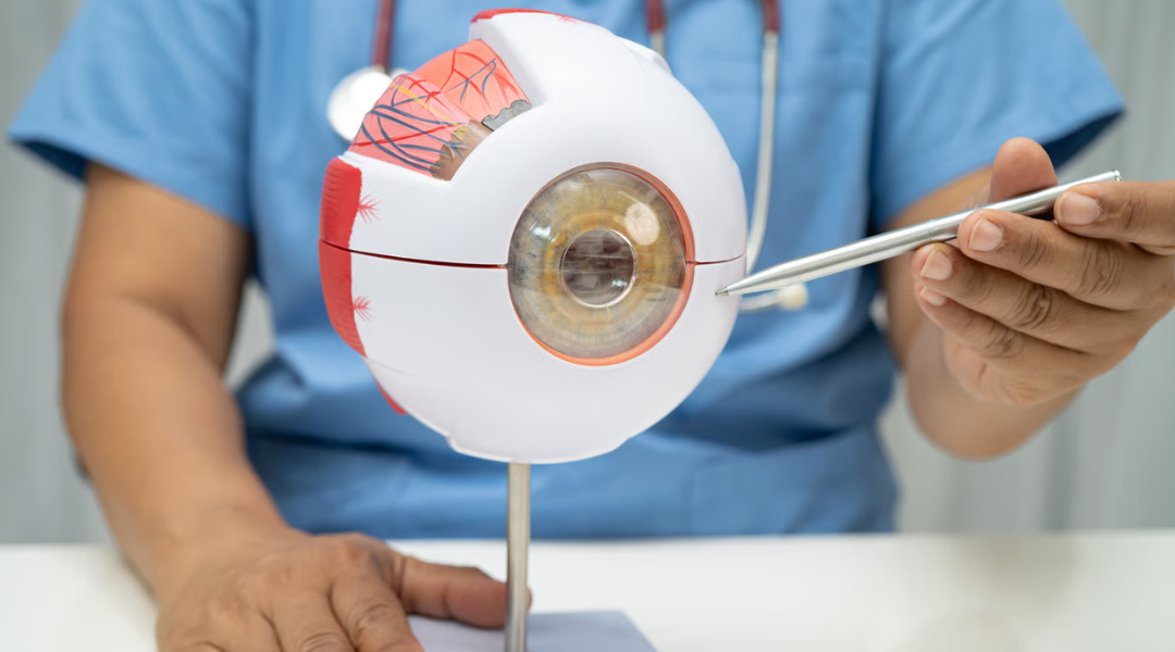Angle Kappa and Lens Surgery: Does It Affect Premium Lens Choice?