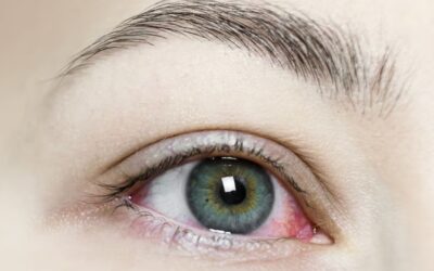 Does ICL Surgery Cause Dry Eye?
